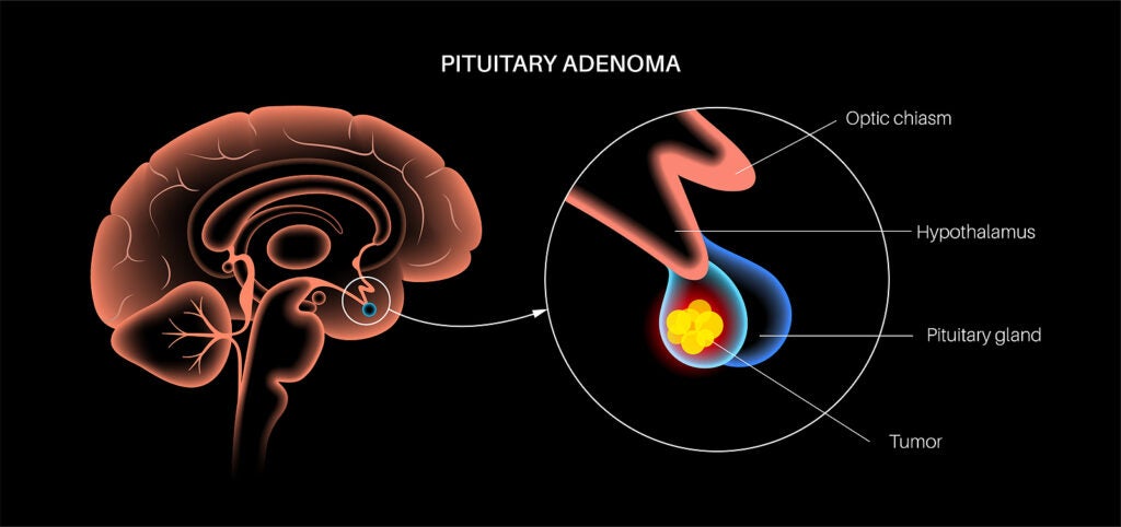 Picture of pituitary adenoma showing optic chiasm, hypothalamus, pituitary gland and tumor; complex medical solutions.